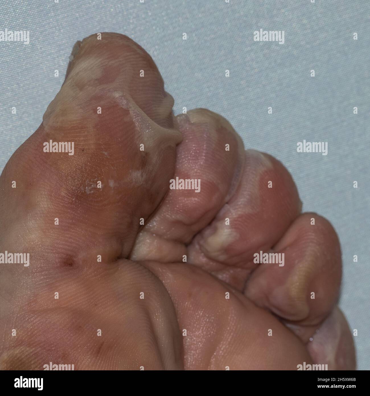 immagini di febbre scarlatta in un uomo caucasico adulto Foto Stock