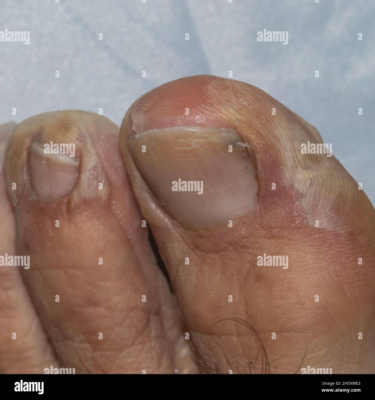 immagini di febbre scarlatta in un uomo caucasico adulto Foto Stock