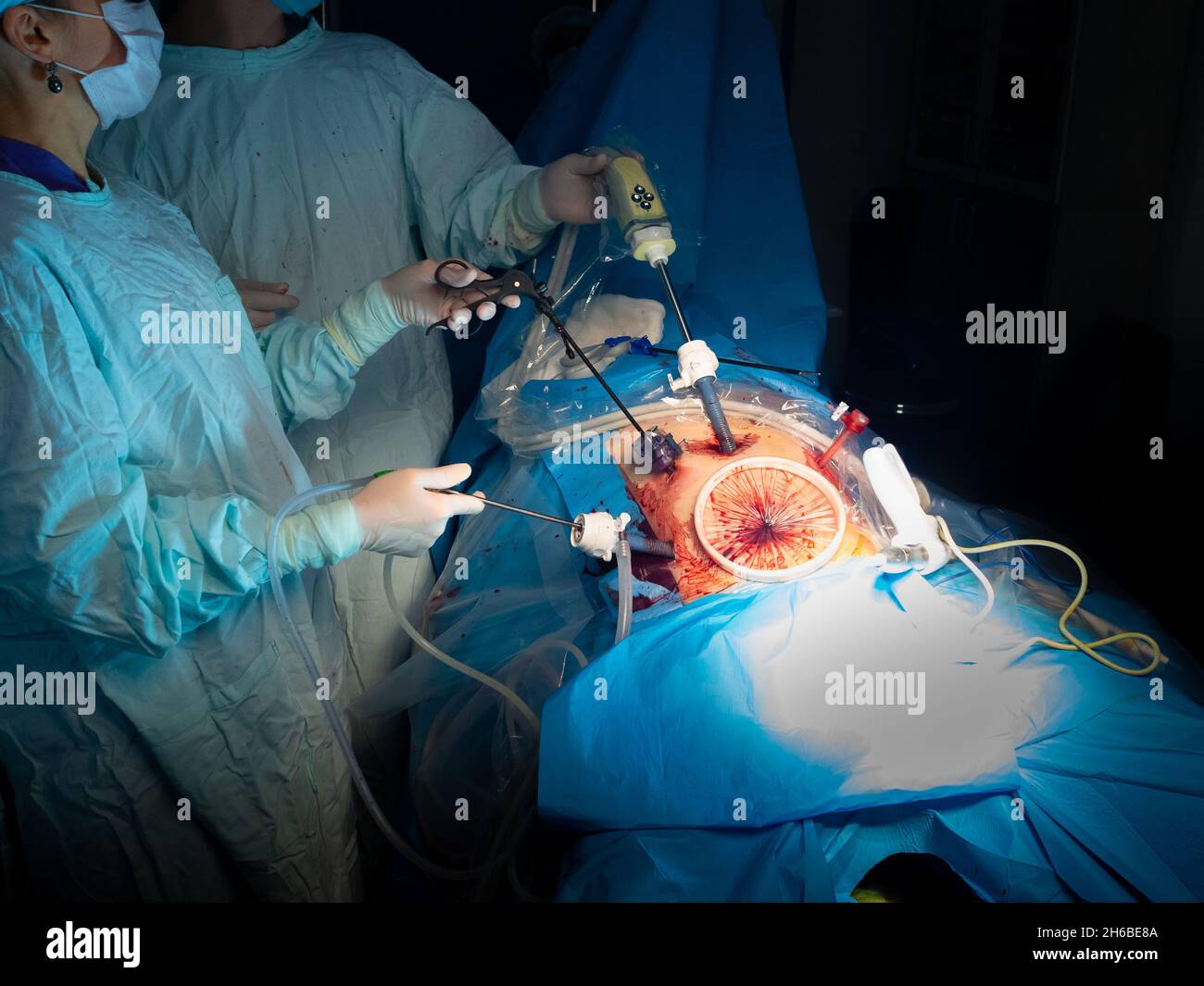 Le mani dei chirurghi eseguono un intervento chirurgico utilizzando manipolatori chirurgici. Messa a fuoco selettiva. Chirurgia laparoscopica minimamente invasiva. Foto Stock