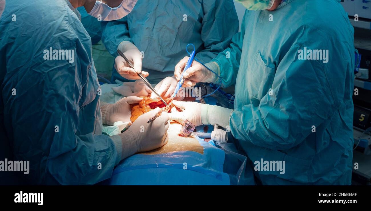 Fuoco selettivo sulle mani dei chirurghi nei guanti sterili durante l'intervento chirurgico. Un gruppo di chirurghi esegue un intervento chirurgico per rimuovere un tumore canceroso. I medici tagliano il tumore maligno. Foto Stock