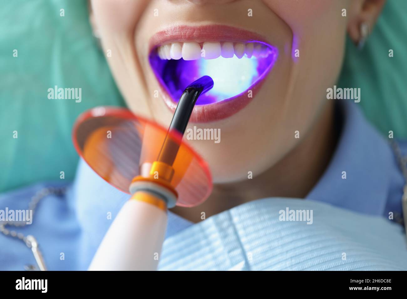 Donna con bocca aperta su appuntamento dentista prova procedura di sbiancamento Foto Stock