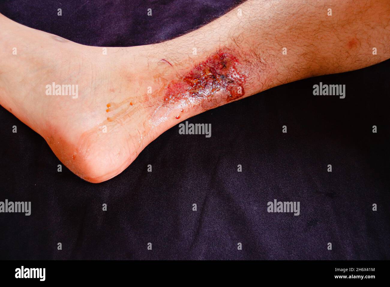Un terzo grado brucia sulla gamba di un maschio caucasico su sfondo nero Foto Stock