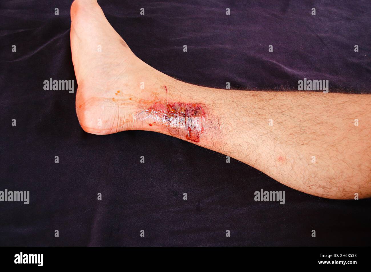 Un terzo grado brucia sulla gamba di un maschio caucasico su sfondo nero Foto Stock