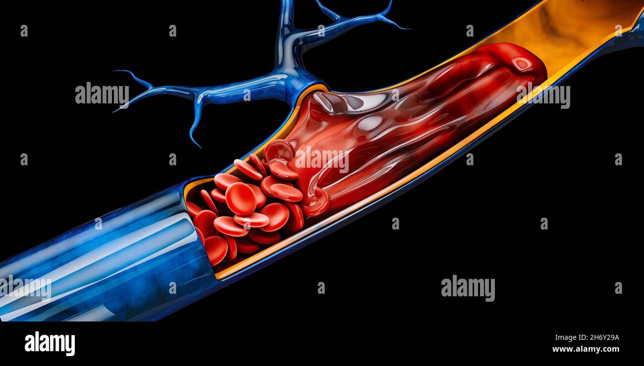 Illustrazione 3d della trombosi venosa profonda o dei coaguli di sangue. Embolia, tracciato di ritaglio incluso. Foto Stock