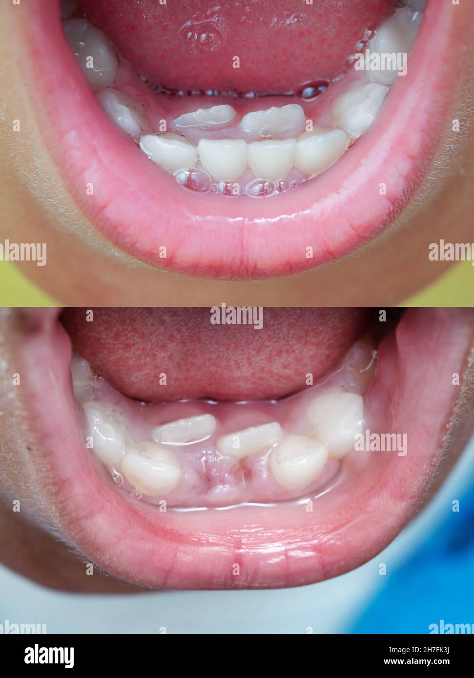 Bambino con due file di denti prima e dopo la rimozione Foto Stock
