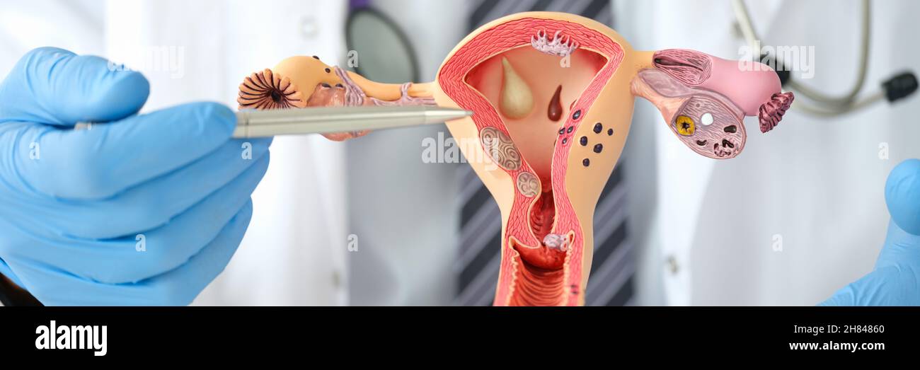 Ginecologo uomo che mostra le malattie femminili con penna su modello artificiale plastico di utero e ovaie closeup Foto Stock