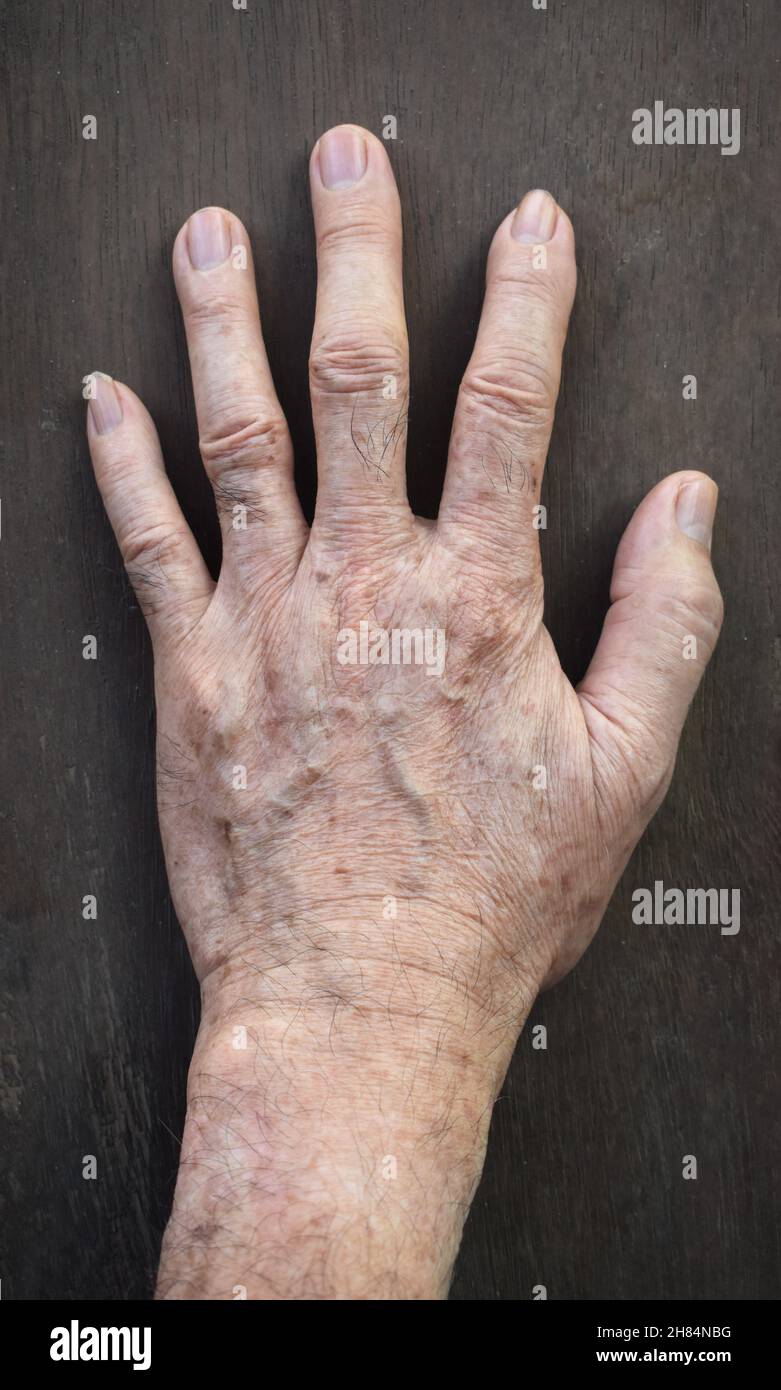 Punti di età sulla mano dell'uomo anziano asiatico. Sono macchie marroni, grigie o nere e anche chiamati macchie di fegato, lentigine senili, lentigine solari, o macchie di sole Foto Stock
