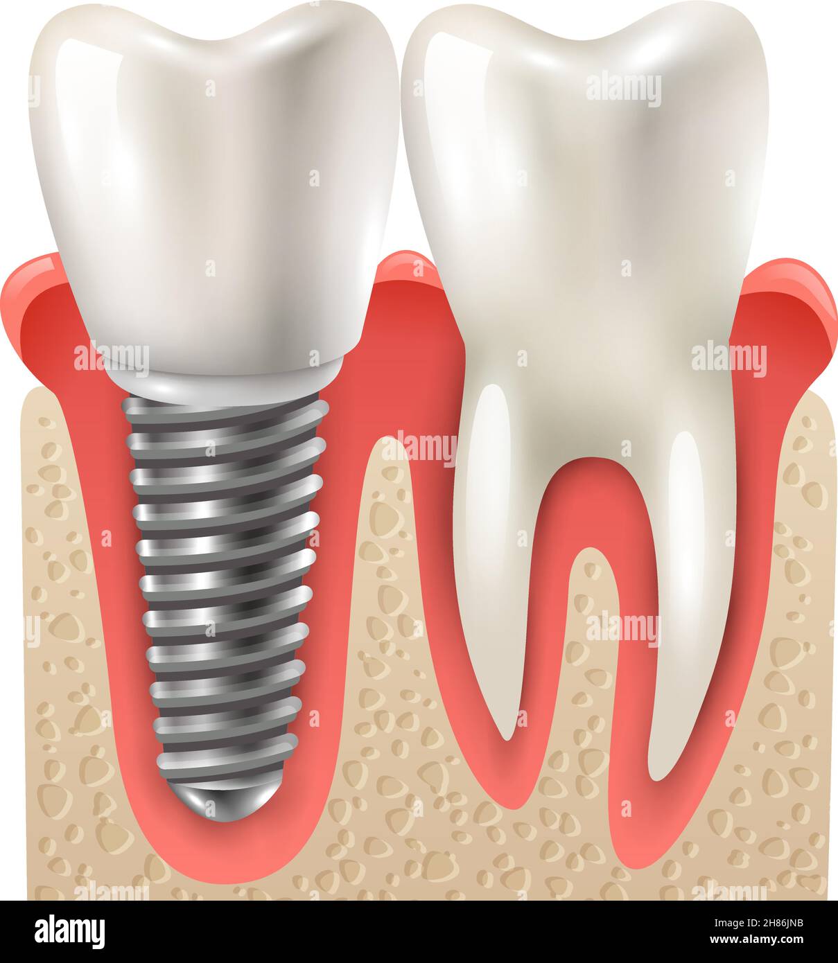 Impianti dentali e set di denti modello closeup vista laterale realistica immagine vettoriale Illustrazione Vettoriale