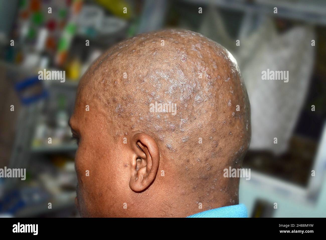 Infezione da tinea al cuoio capelluto dell'uomo asiatico. Si tratta di un'infezione fungina che causa scaly e prurito. Foto Stock