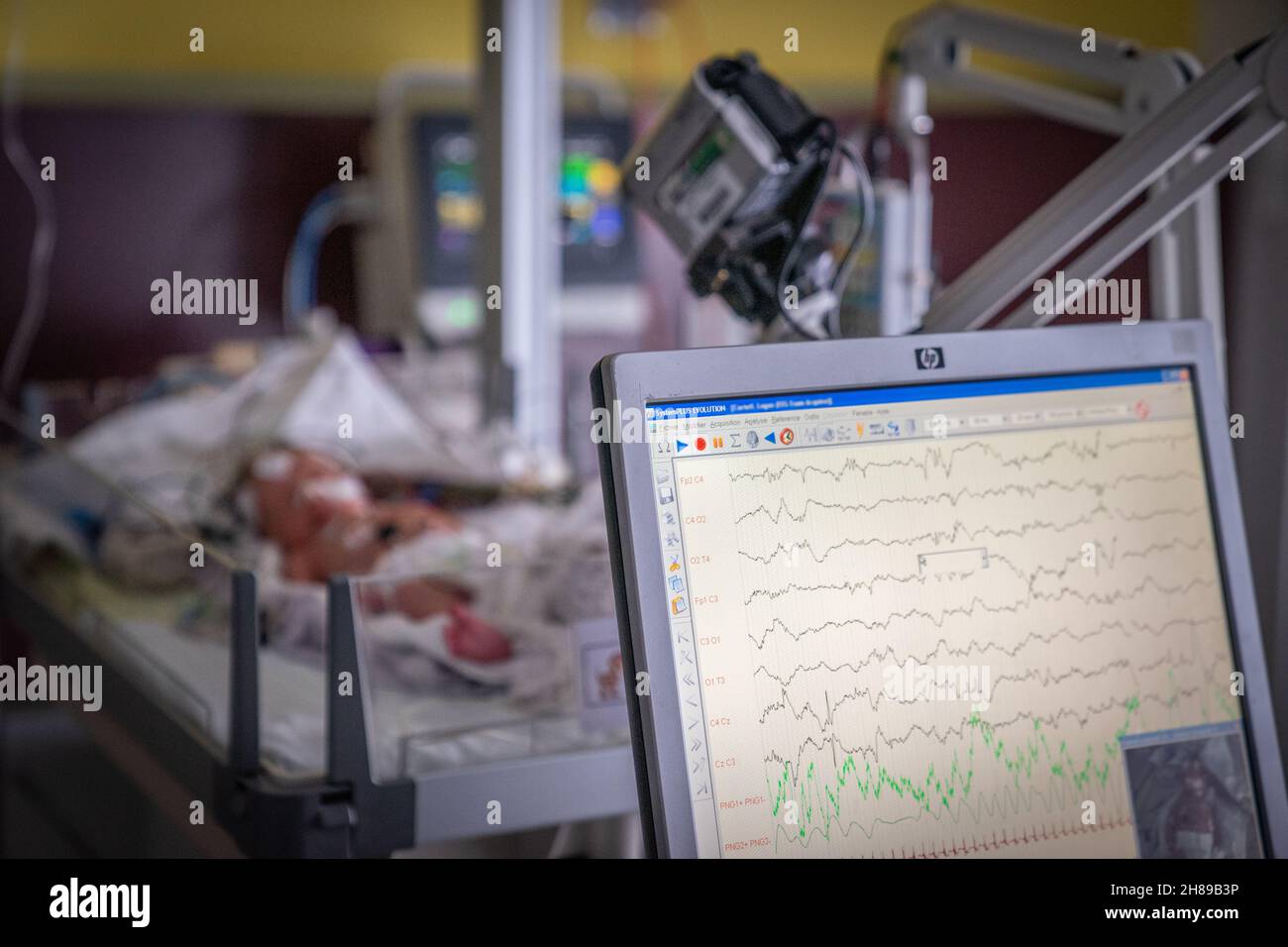 Elettroencefalogramma, bambino Foto Stock