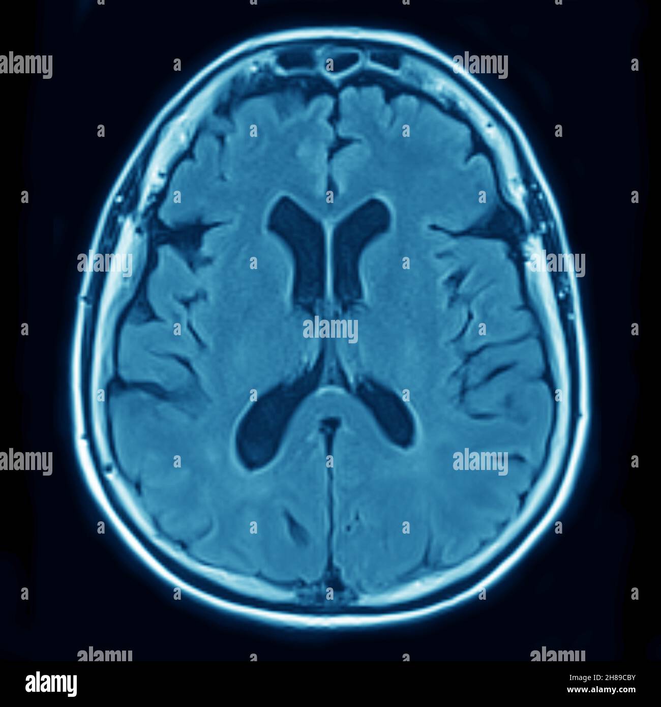 Atrofia cerebrale Foto Stock