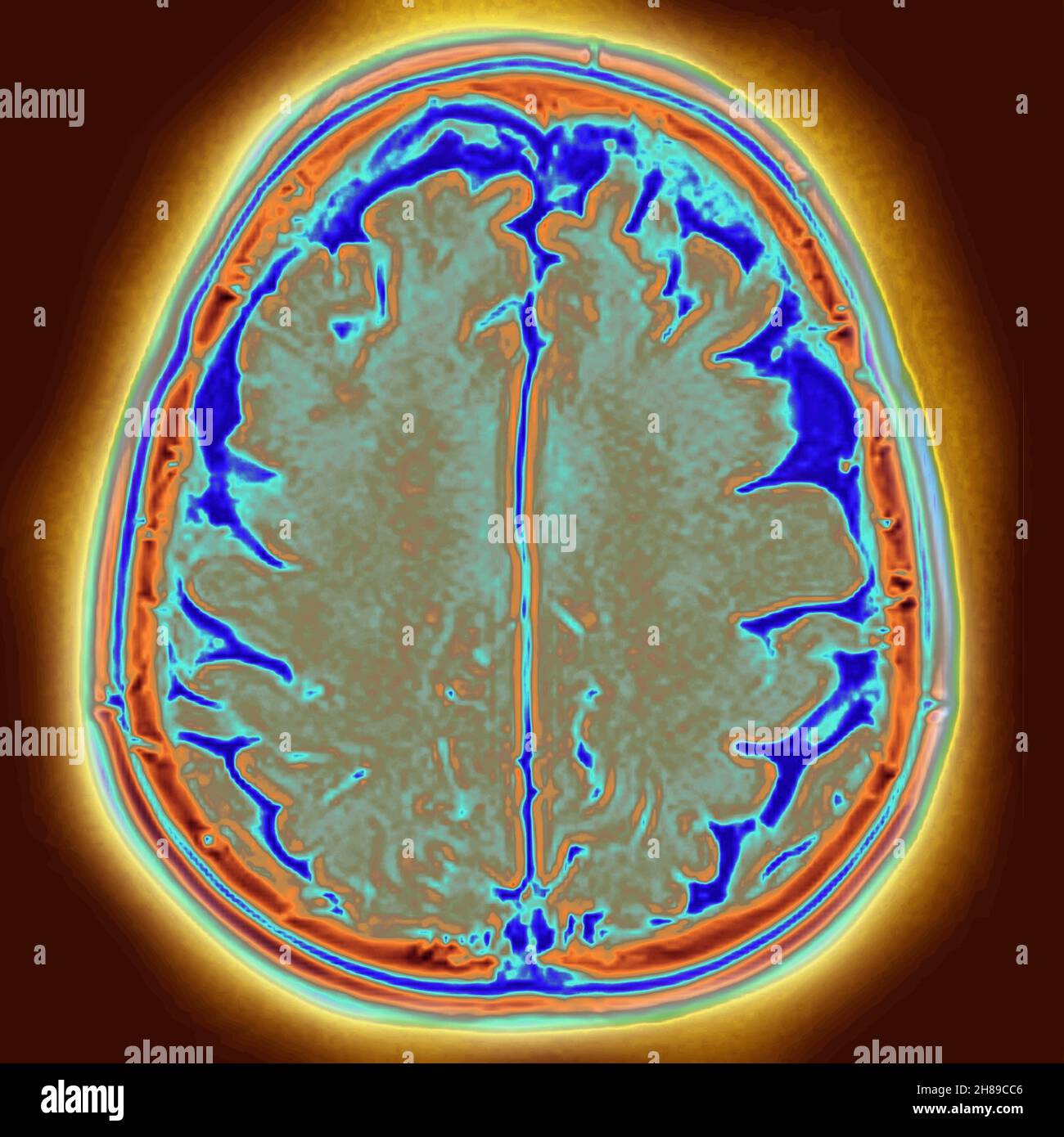 Atrofia cerebrale Foto Stock