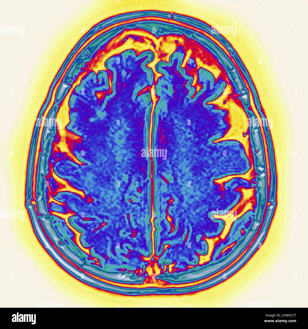 Atrofia cerebrale Foto Stock