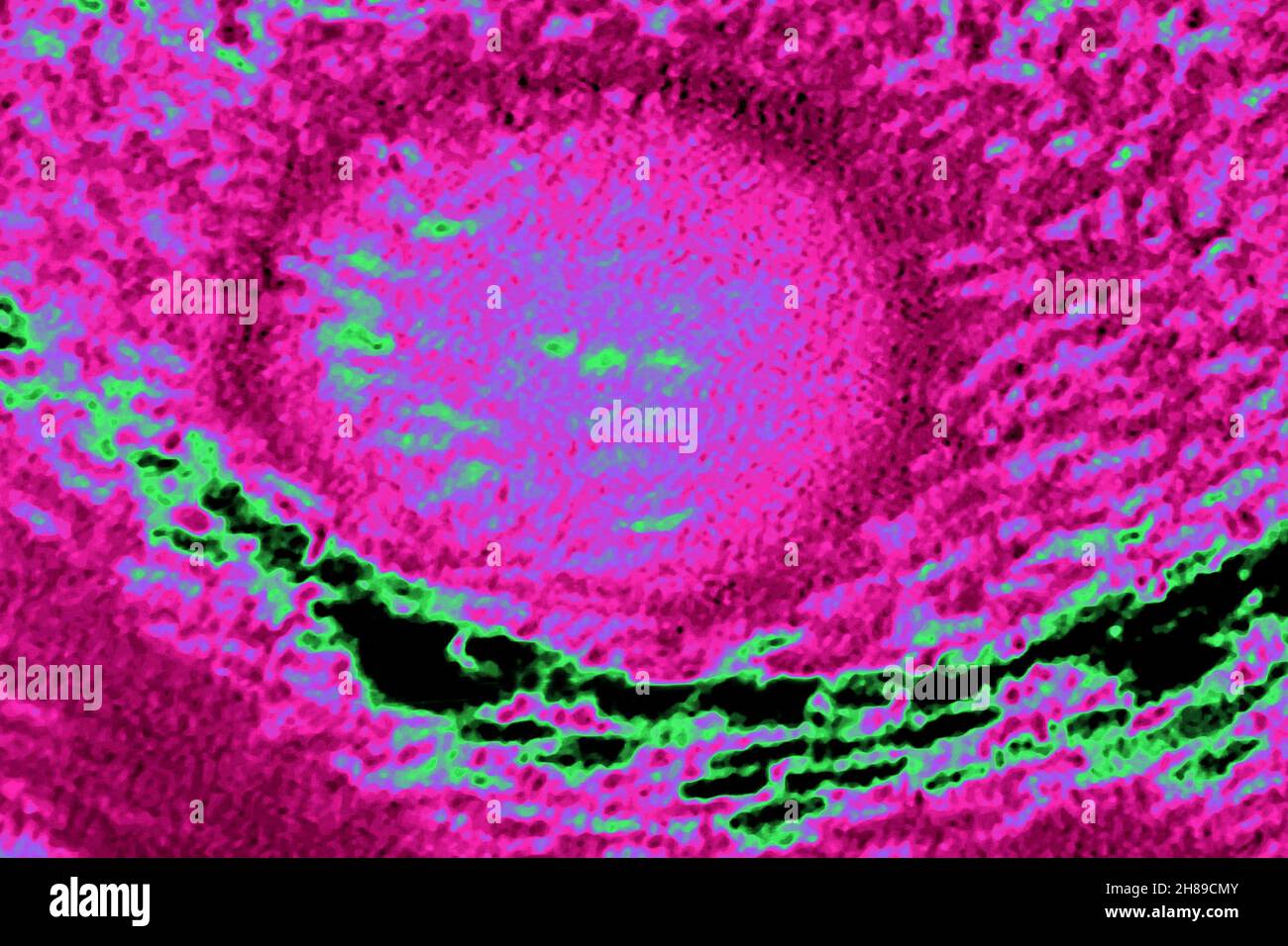 Cancro testicolare Foto Stock