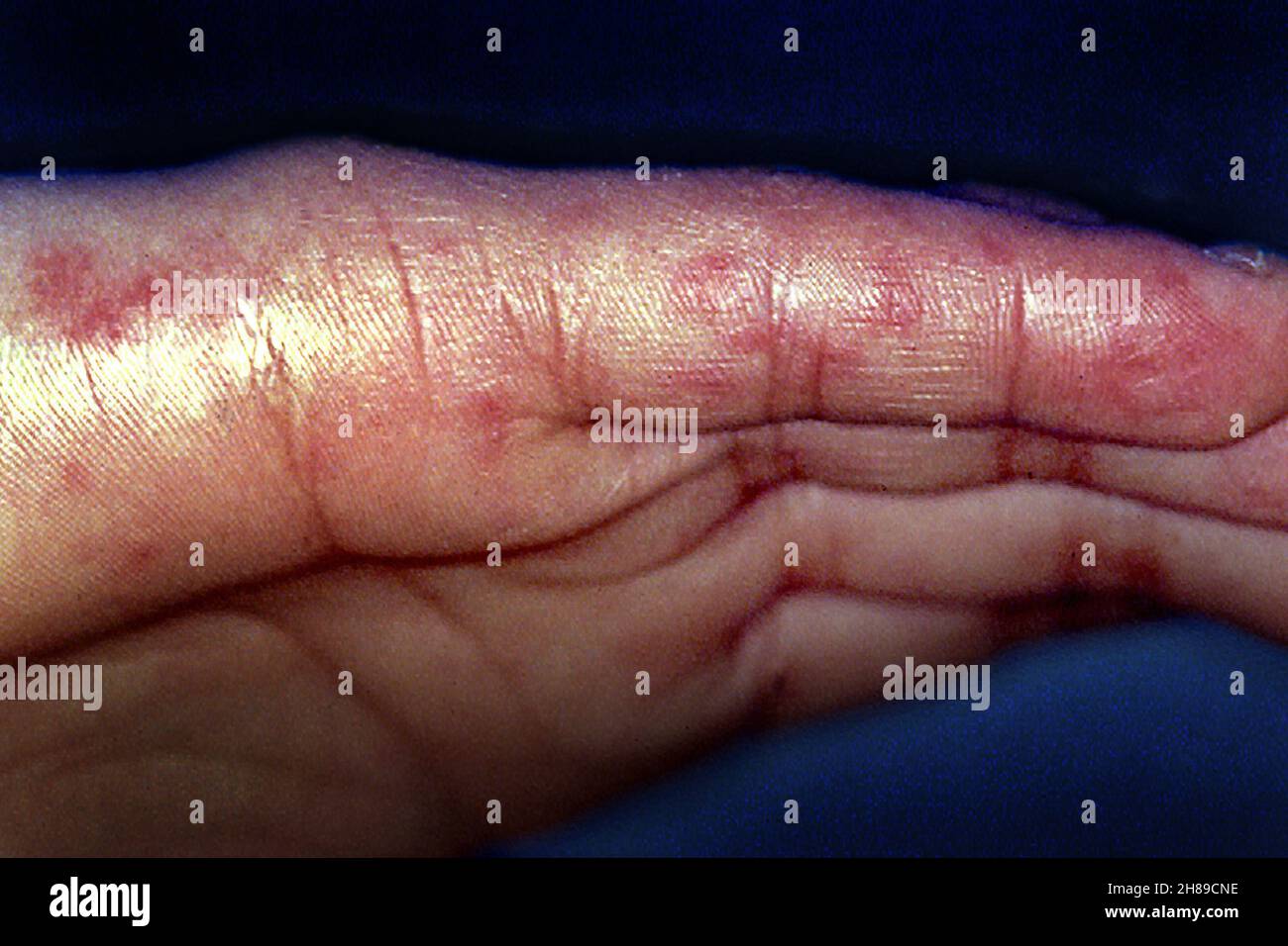 Lupus eritematoso sistemico Foto Stock