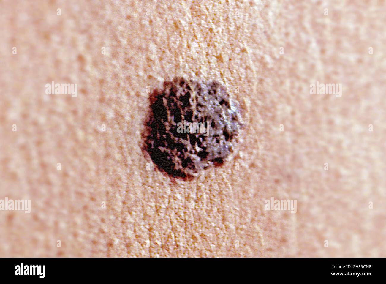 Il melanoma maligno Foto Stock