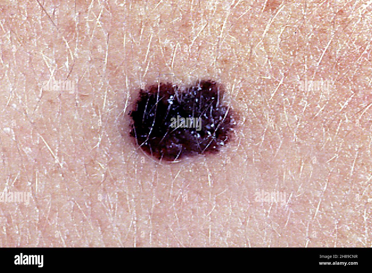 Il melanoma maligno Foto Stock