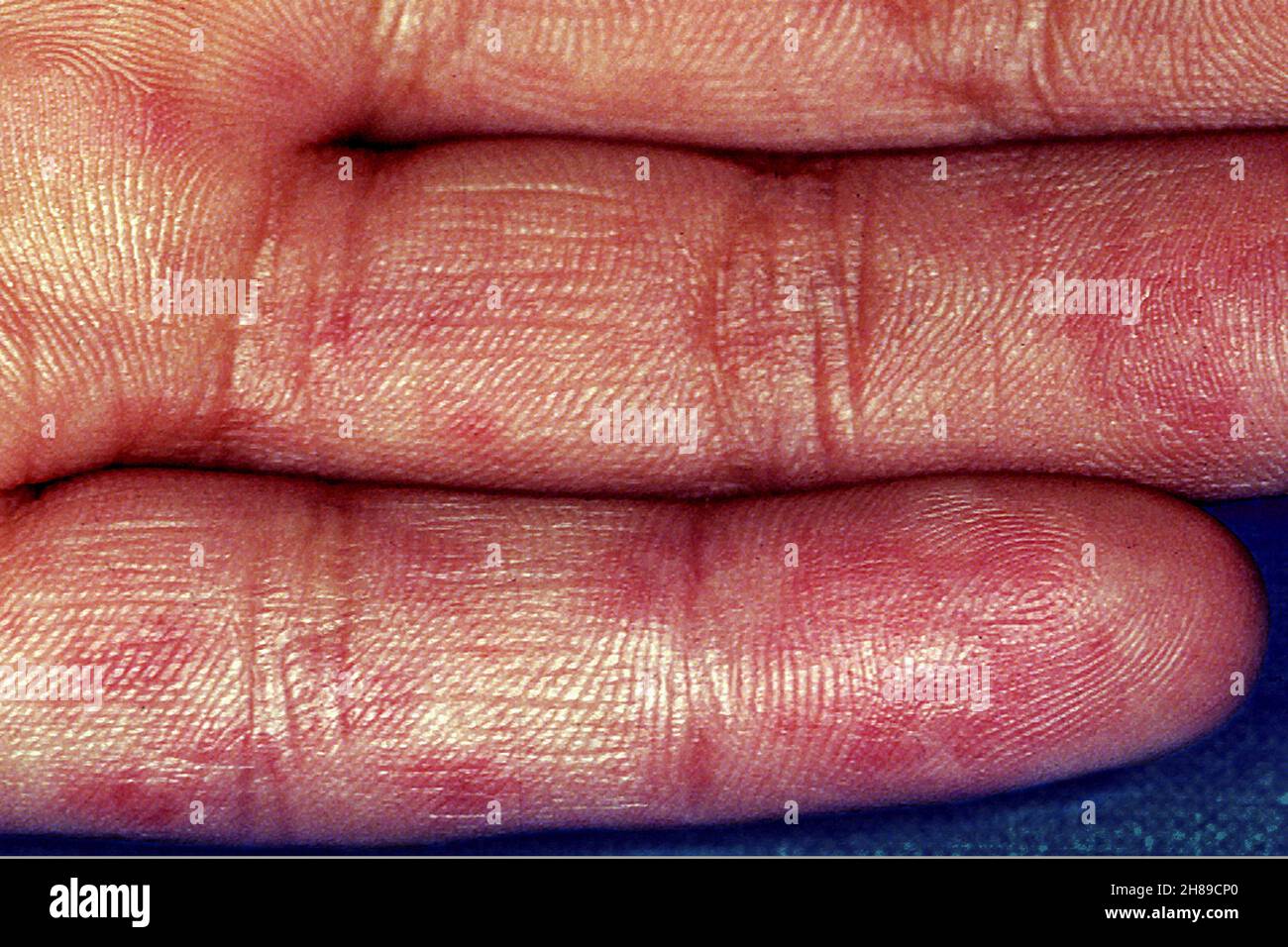 Lupus eritematoso sistemico Foto Stock
