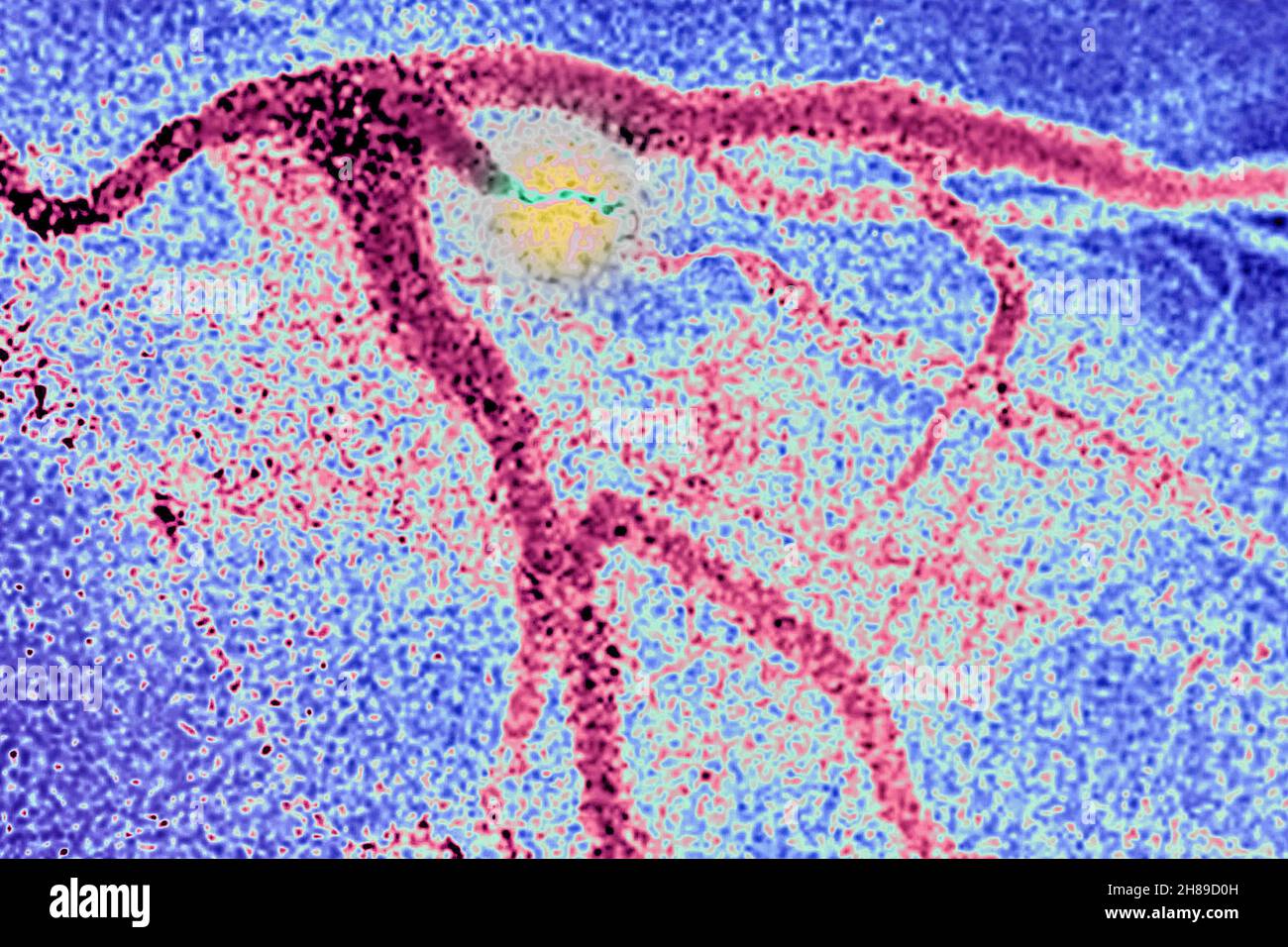 Infarto miocardico Foto Stock