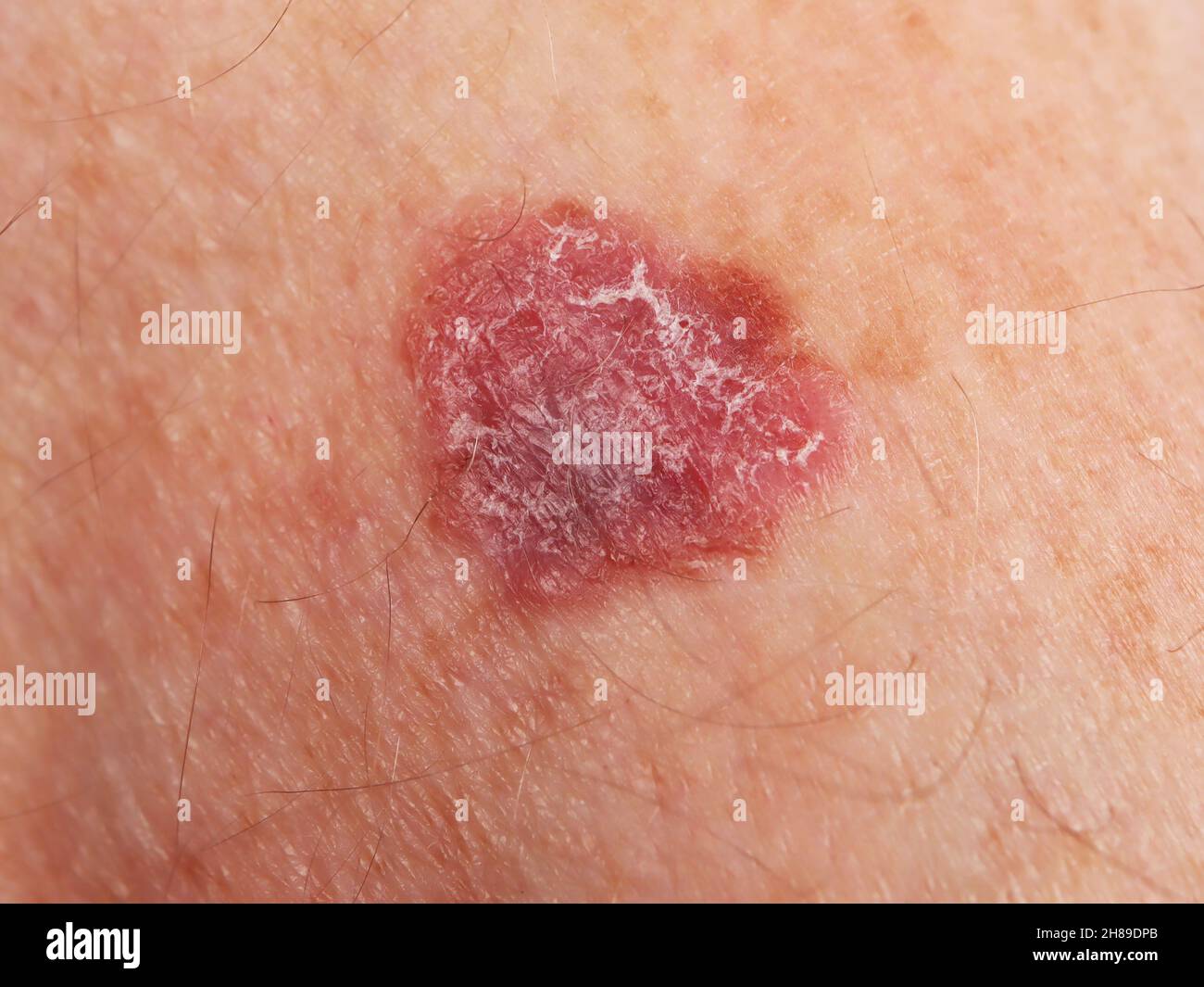 foto di melanoma della pelle