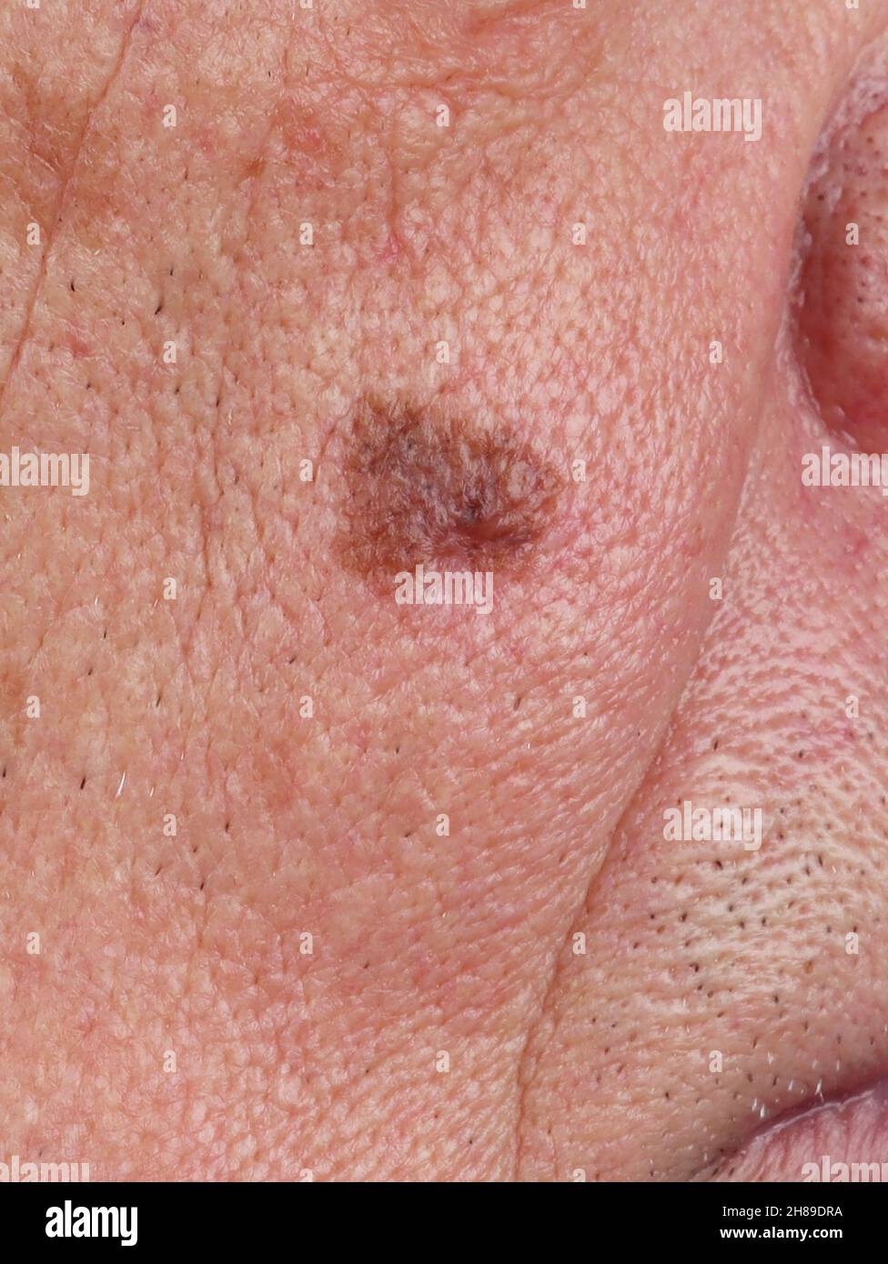 Il melanoma Dubreuilh Foto Stock