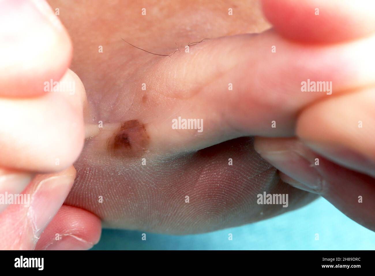 Nevo inter toe Foto Stock