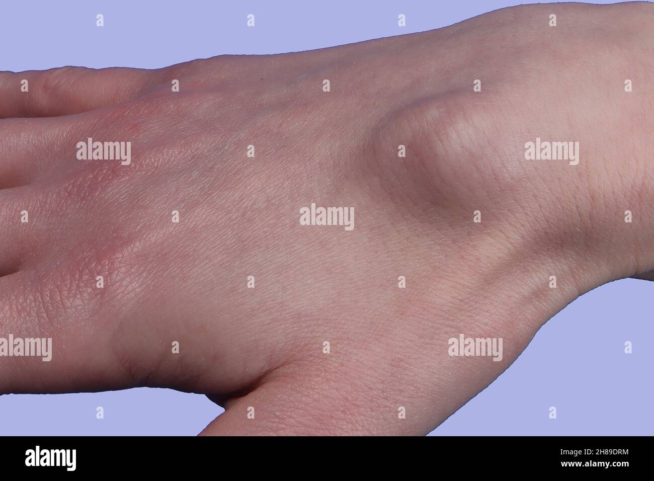 Cisti sinoviale Foto Stock