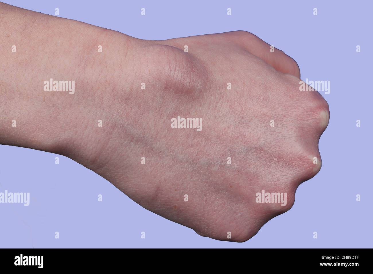 Cisti sinoviale Foto Stock