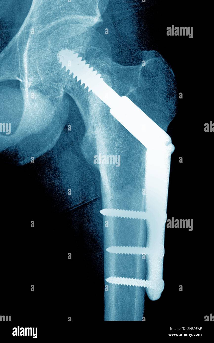 Osteosintesi dell'anca Foto Stock
