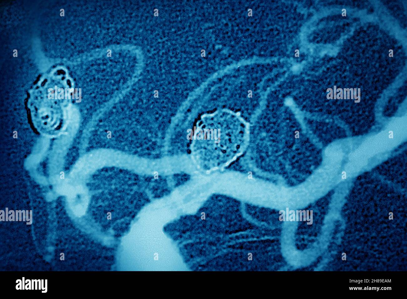 Embolizzazione degli aneurismi cerebrali Foto Stock