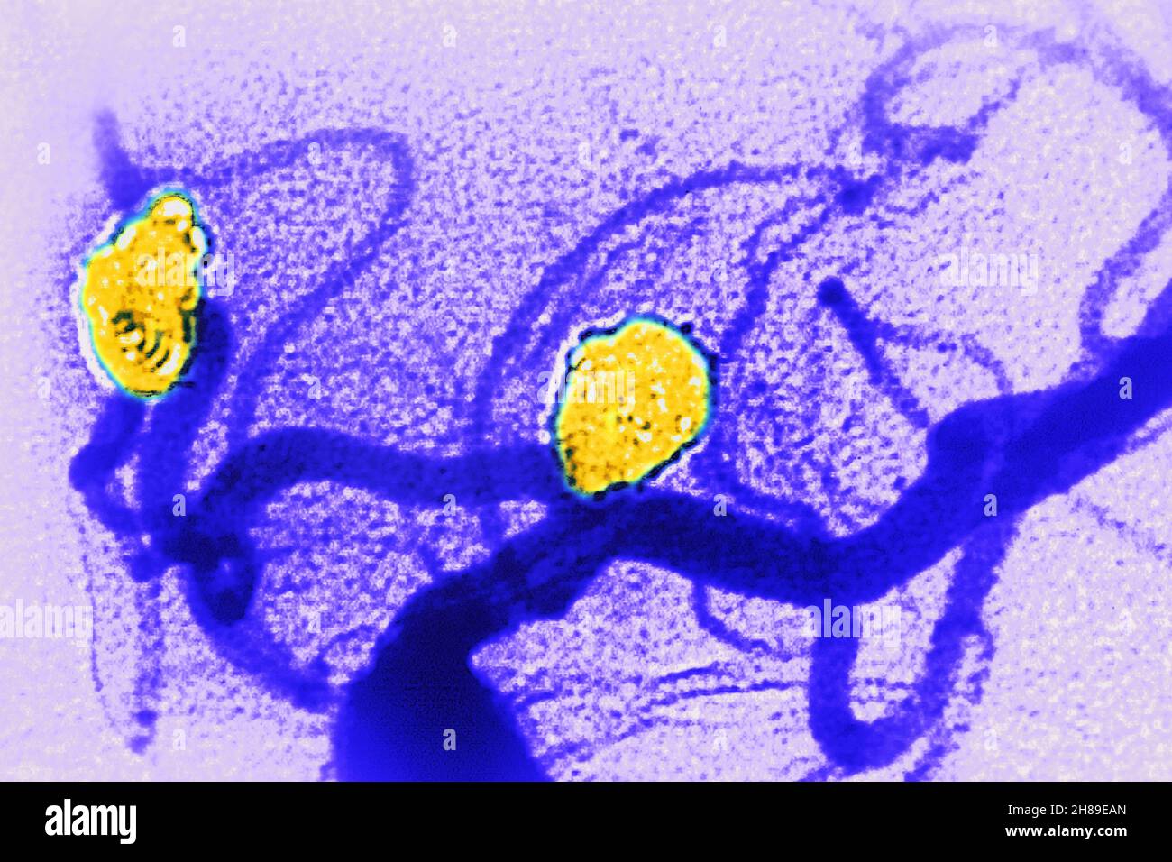 Embolizzazione degli aneurismi cerebrali Foto Stock