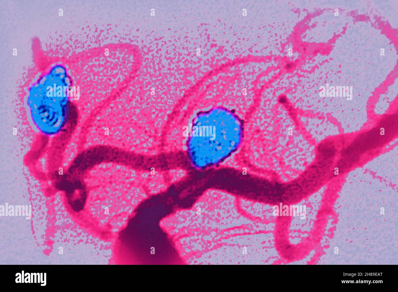 Embolizzazione degli aneurismi cerebrali Foto Stock