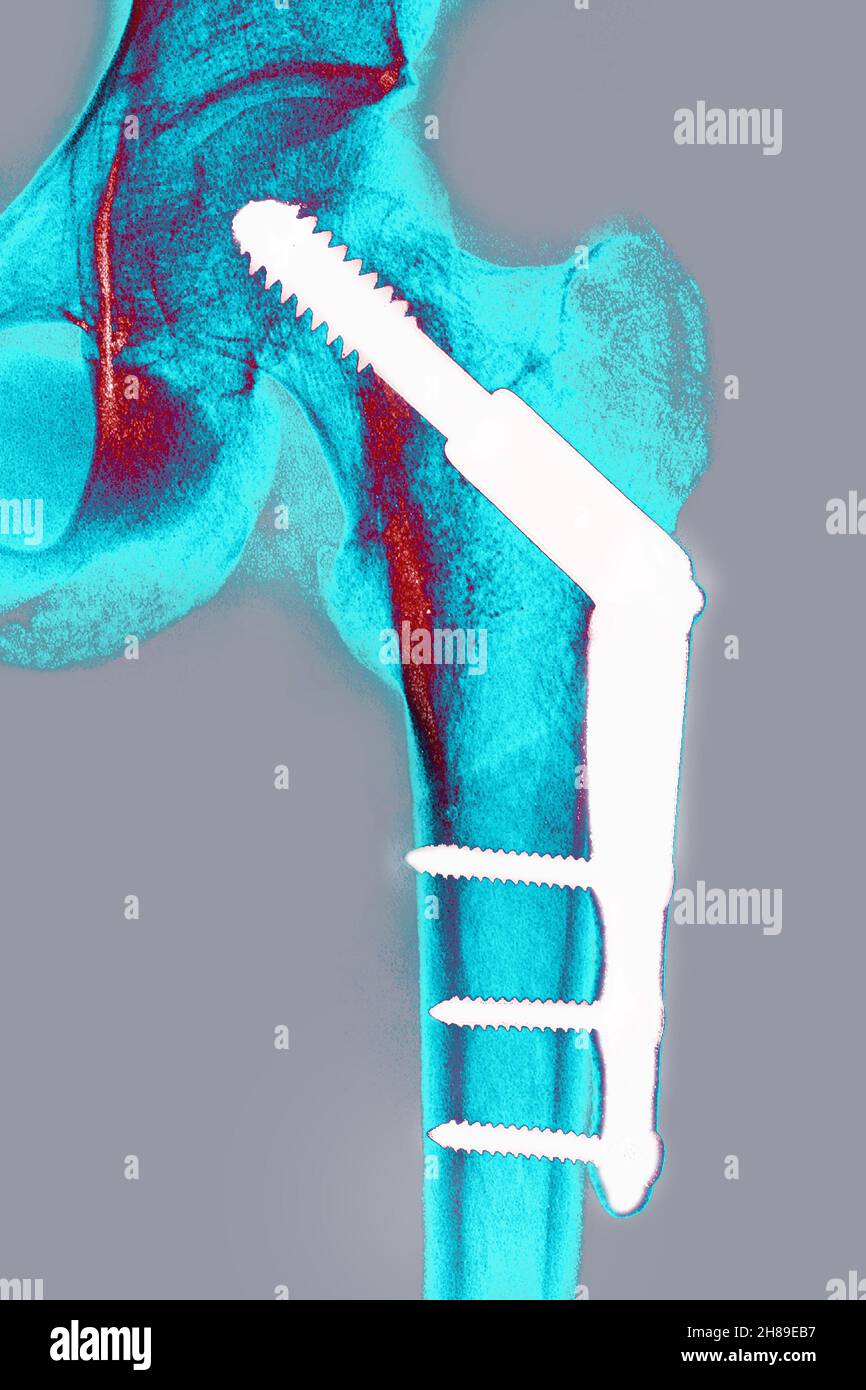 Osteosintesi dell'anca Foto Stock