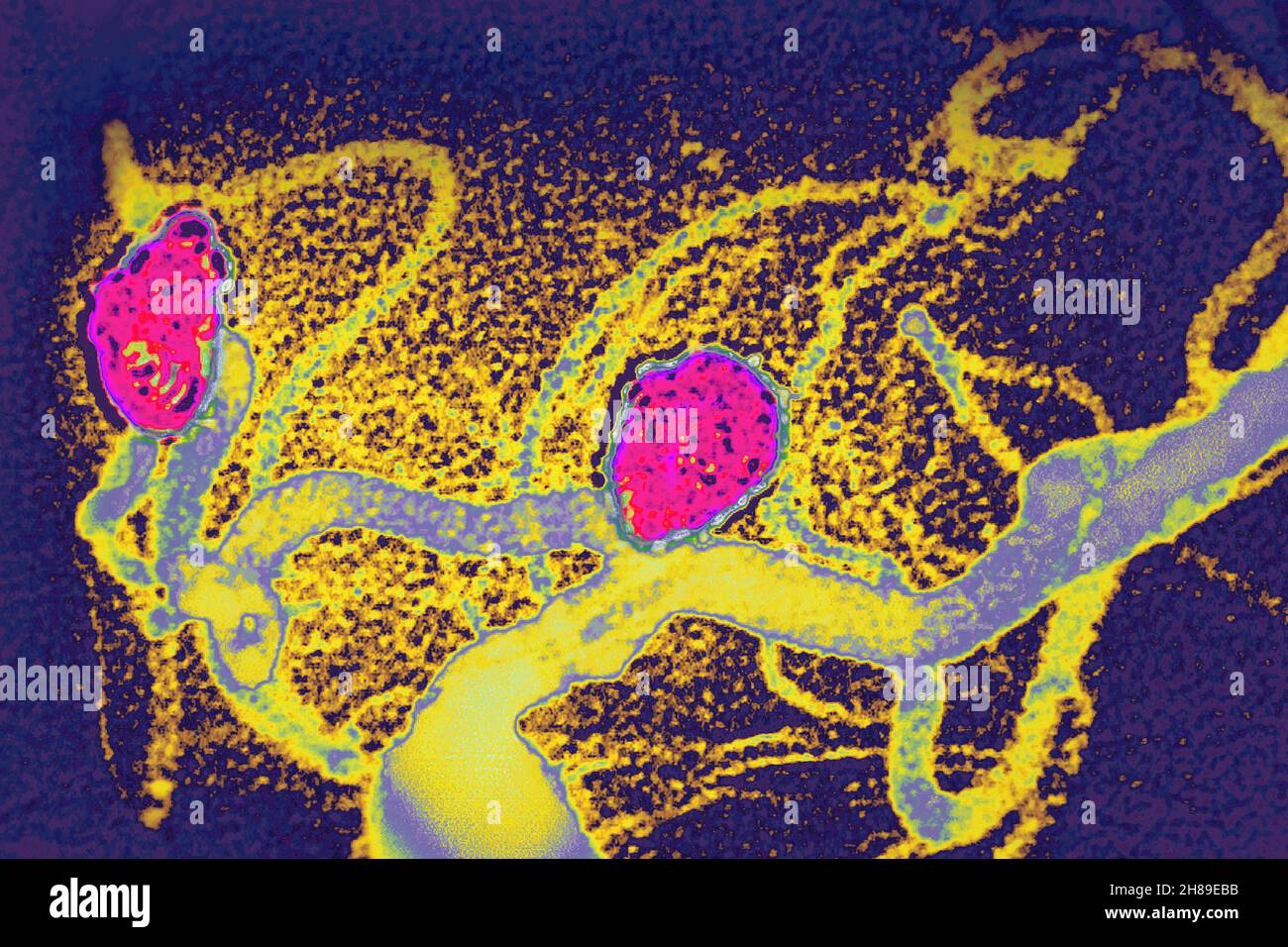 Embolizzazione degli aneurismi cerebrali Foto Stock