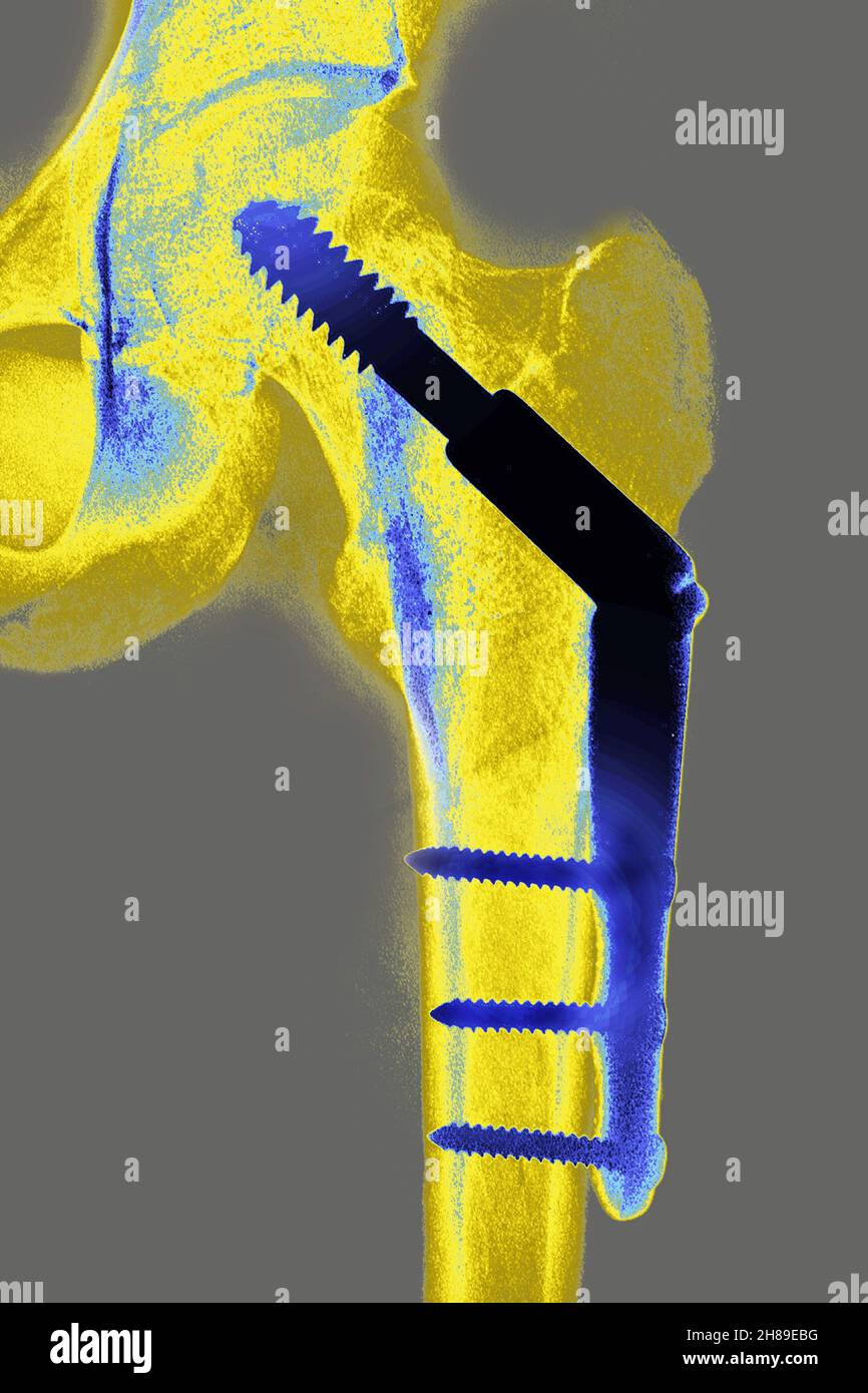 Osteosintesi dell'anca Foto Stock