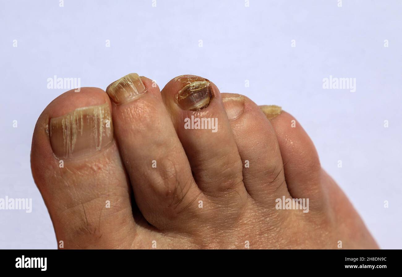Piede di un uomo con infezione fungina sulle sue dita Foto Stock