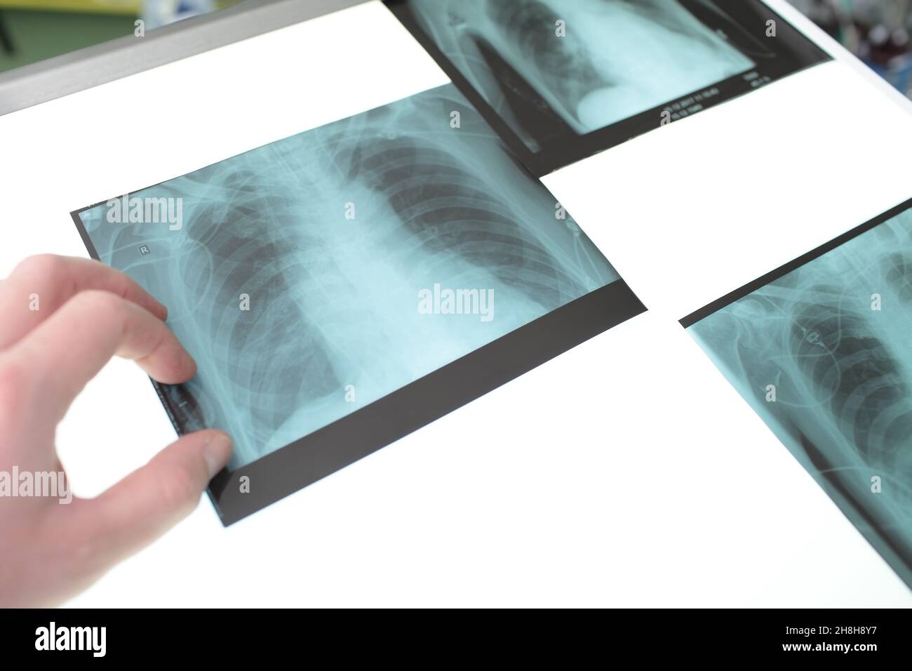 Serie di immagini radiologiche sul visualizzatore di raggi X nello sbraccio. Foto Stock