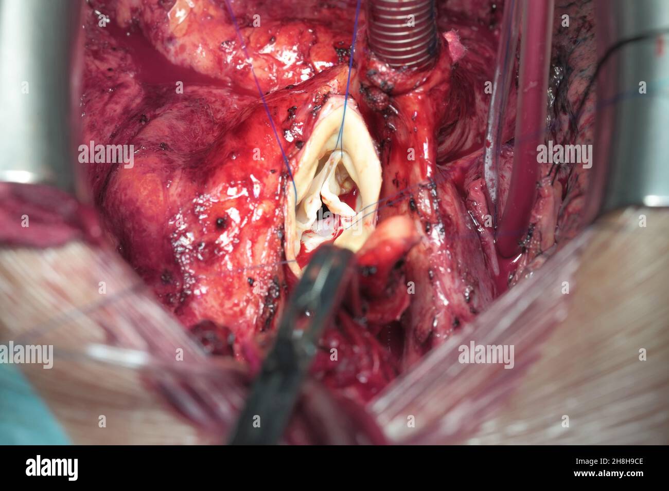 Primo piano di chirurgia cardiaca. Aprire il cuore con i tubi collegati e gli strumenti chirurgici. Foto Stock