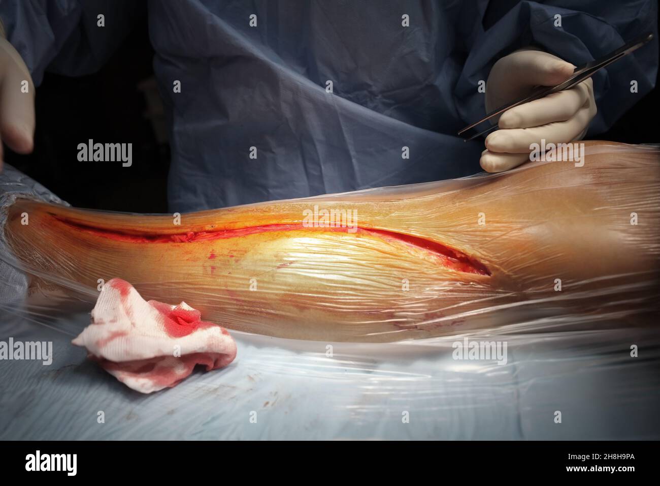 Il chirurgo inizia la procedura chirurgica con una sezione cutanea. Foto Stock