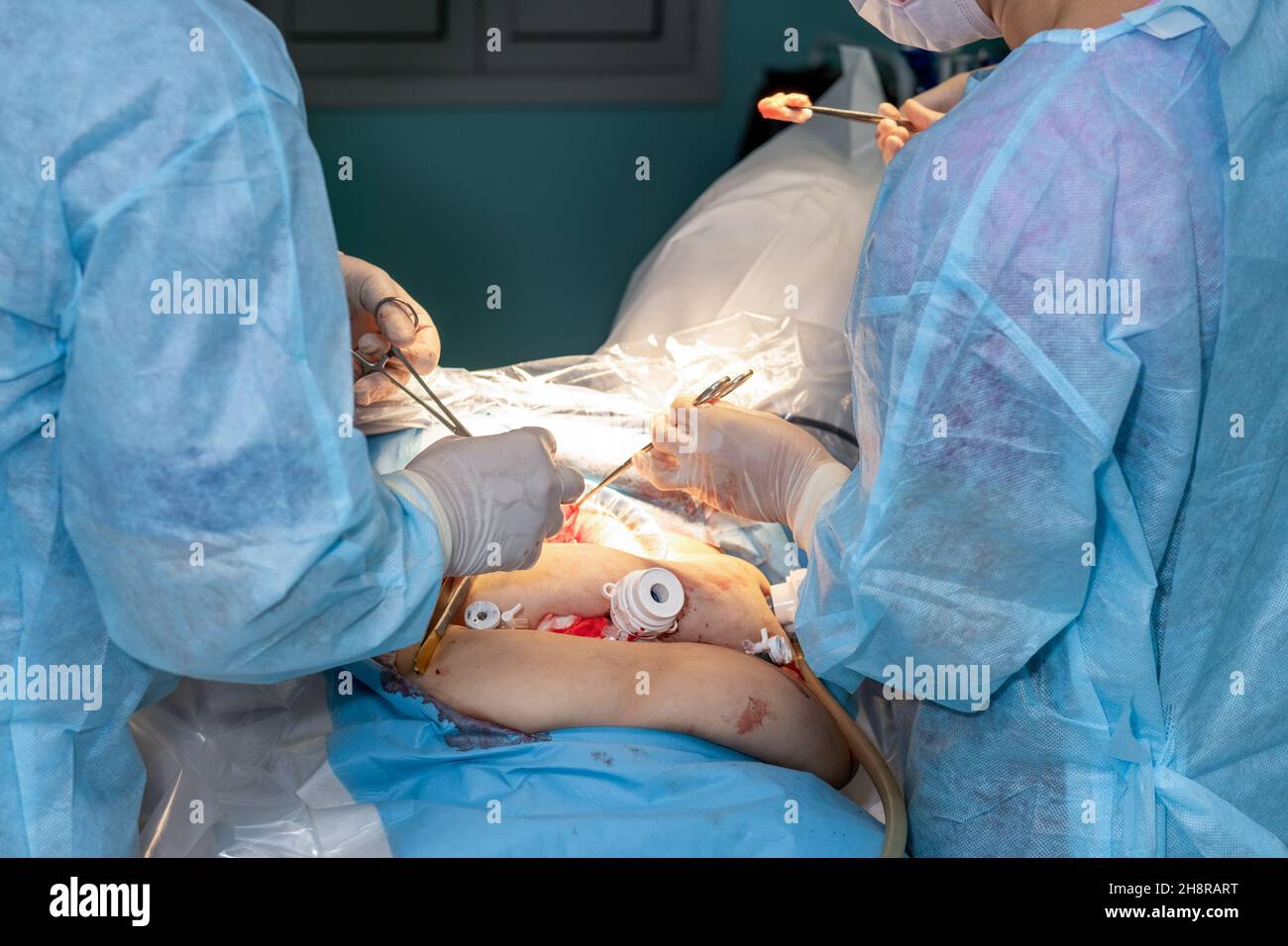 Il primo piano delle mani di un chirurgo in guanti sterili lavora con strumenti medici durante un intervento chirurgico. Il medico utilizza una varietà di strumenti medici per eseguire l'intervento chirurgico. Foto Stock