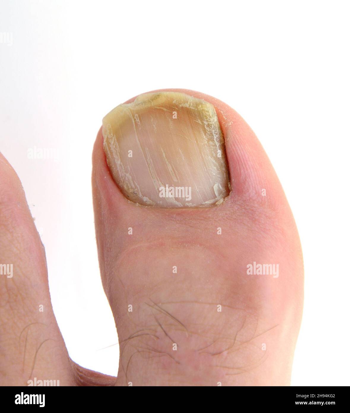 Onicomicosi. Foto Stock