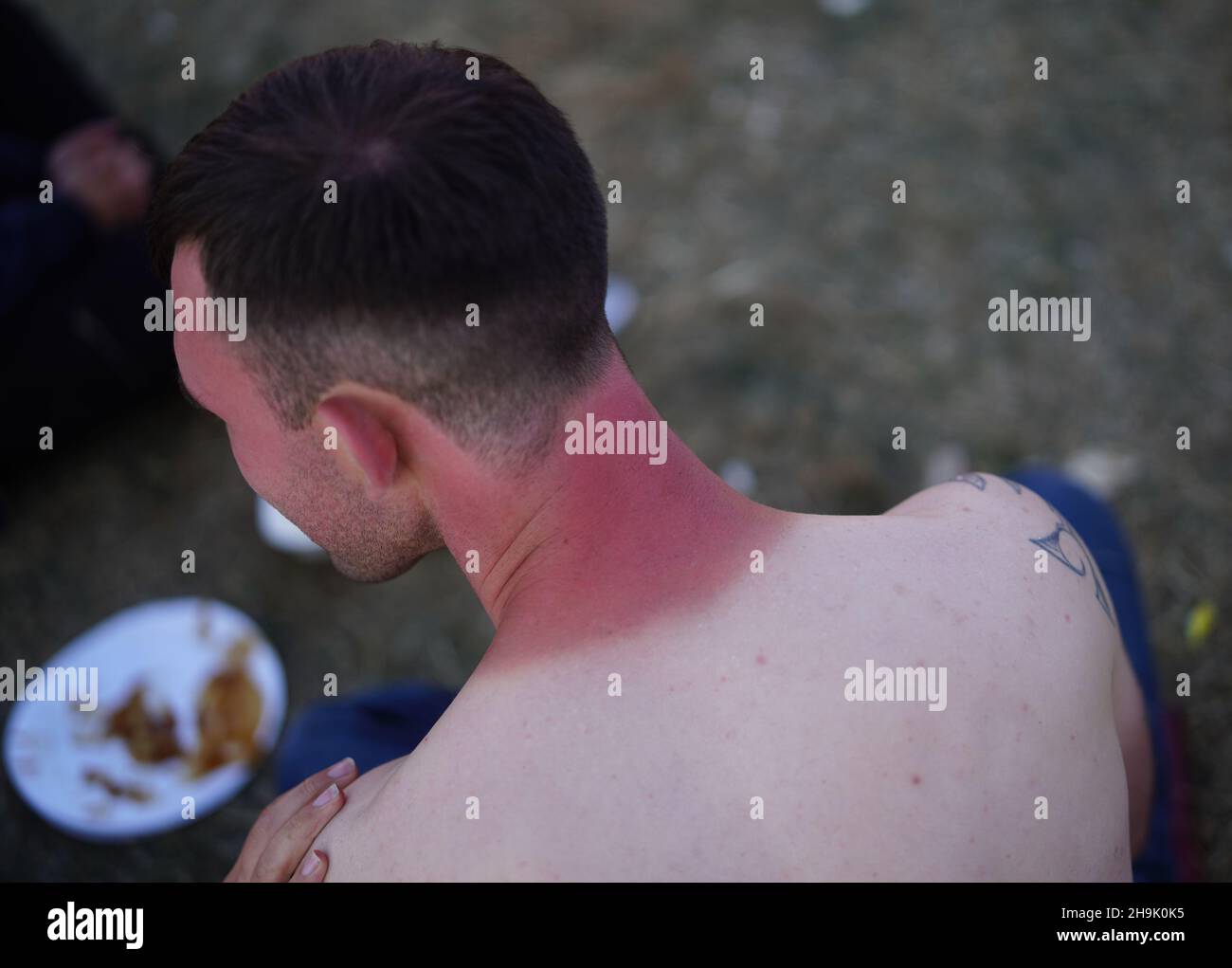 Il collo di un uomo bruciato dal sole al Reading Festival del 2018. Data foto: Sabato 25 agosto 2018. Il credito fotografico dovrebbe essere: Richard Grey/EMPICS Foto Stock