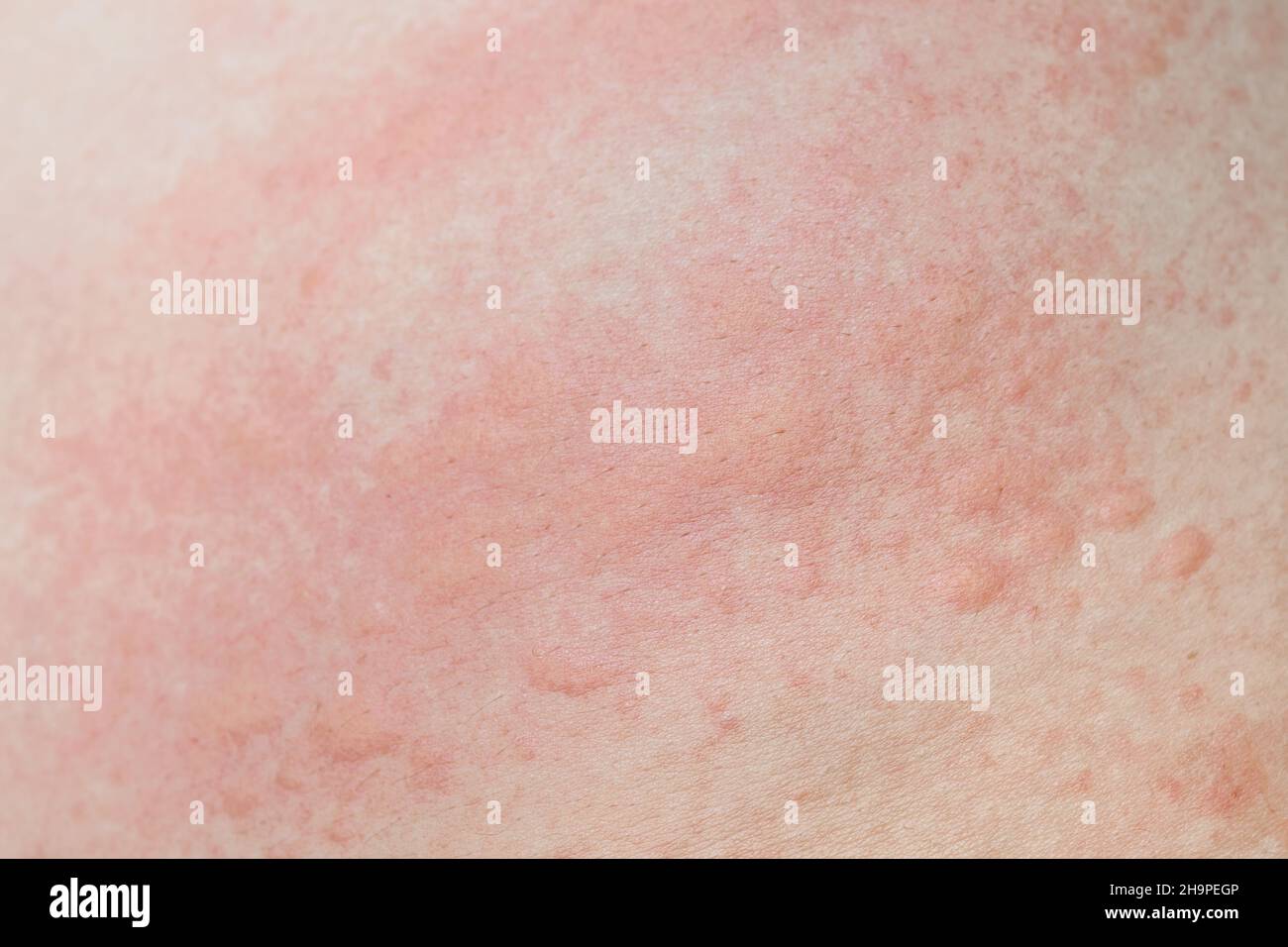 Allergie Juckreiz Am Ganzen Körper