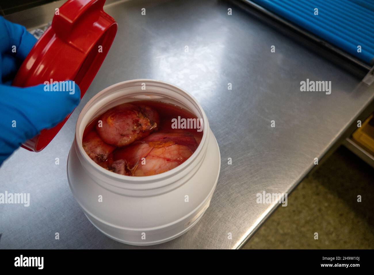 un tumore di grandi dimensioni, che è stato rimosso, è stato decapato in formalina Foto Stock