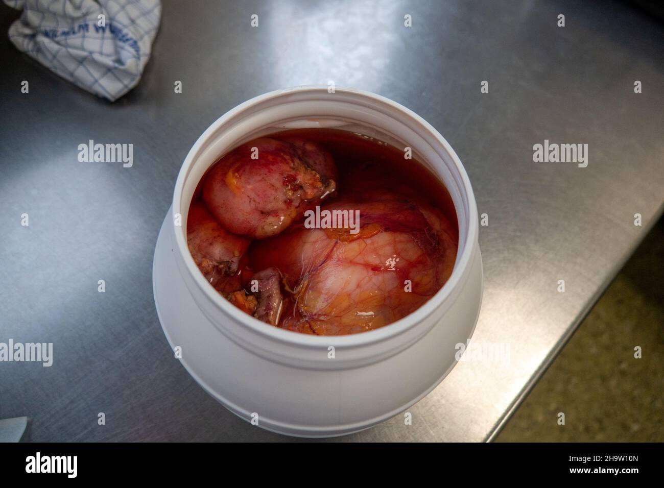 un tumore di grandi dimensioni, che è stato rimosso, è stato decapato in formalina Foto Stock