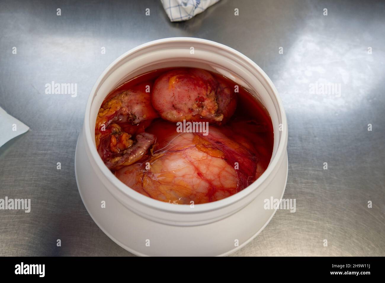 un tumore di grandi dimensioni, che è stato rimosso, è stato decapato in formalina Foto Stock