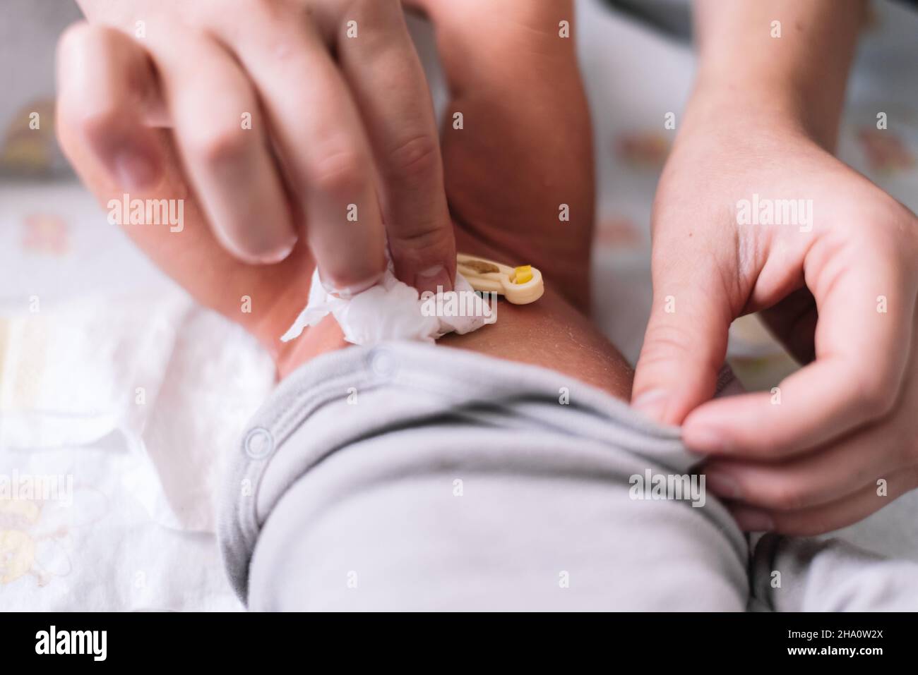 Trattamento dell'ombelico neonato con tampone di cotone Foto stock - Alamy