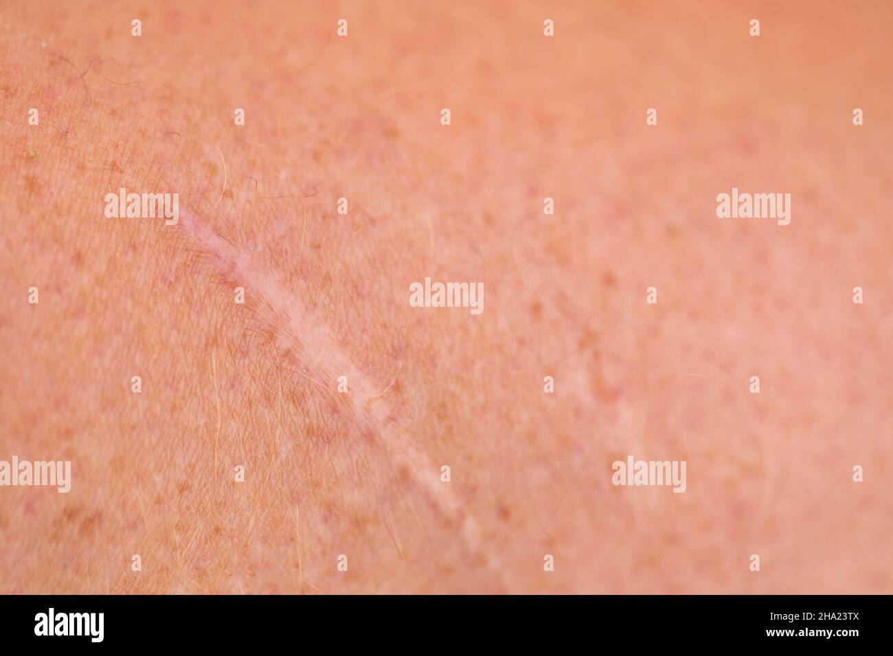 Primo piano della cicatrice keloide cianotica Foto Stock