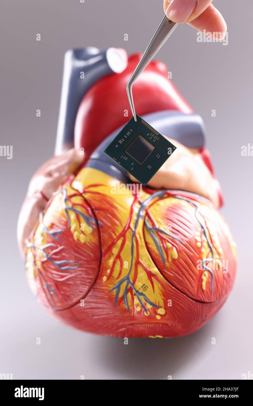 Modello di cuore con pacemaker cardiaco in forma di chip Foto Stock