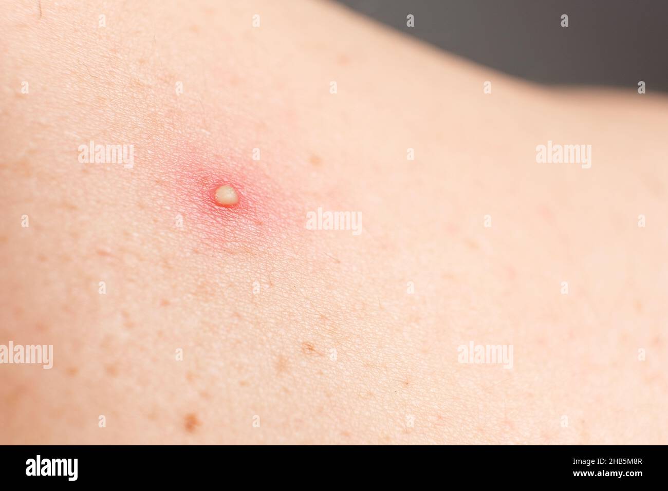 Pimple sul corpo umano, problemi della pelle Foto stock - Alamy